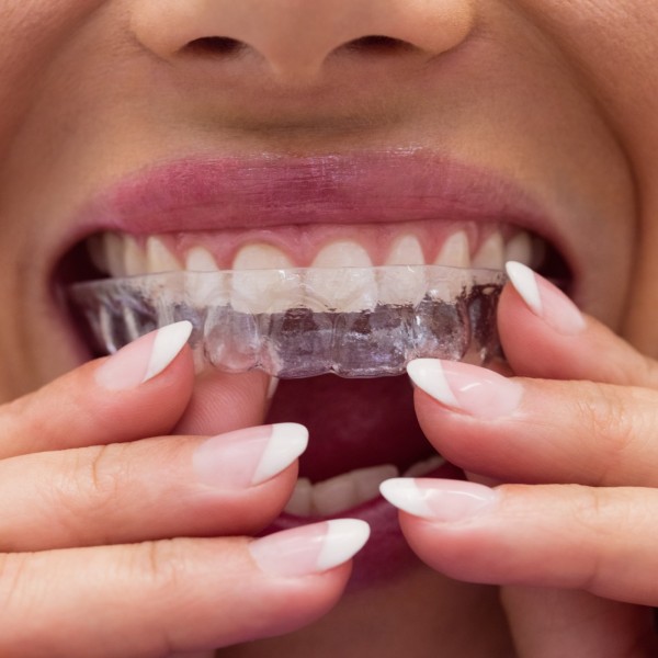 Orthodontics for adults with Invisalign